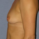 Breast Augmentation Before & After Patient #3856