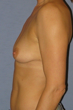 Breast Augmentation Before & After Patient #3856