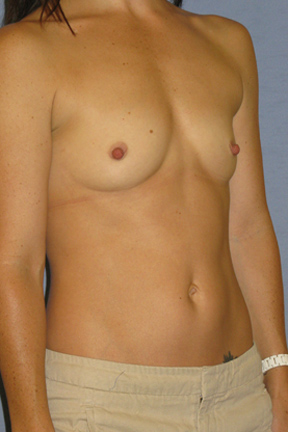 Breast Augmentation Before & After Patient #3868