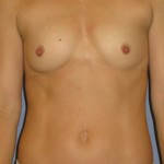 Breast Augmentation Before & After Patient #3868