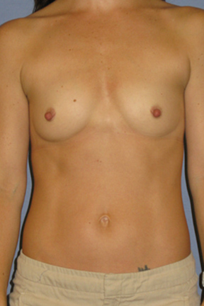 Breast Augmentation Before & After Patient #3868