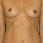 Breast Augmentation Before & After Patient #3932