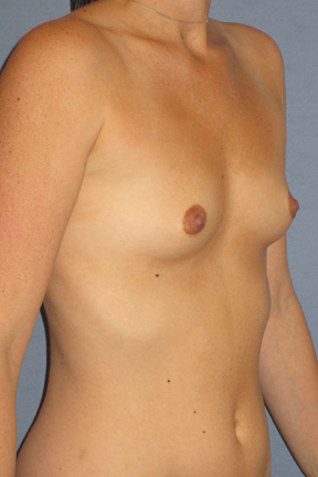 Breast Augmentation Before & After Patient #3652