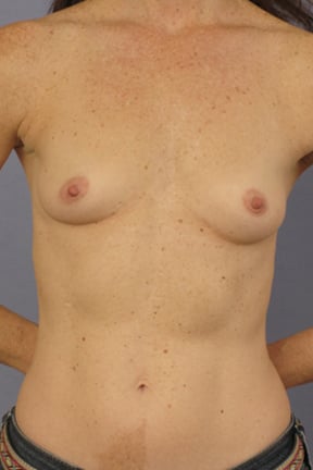 Breast Augmentation Before & After Patient #3873