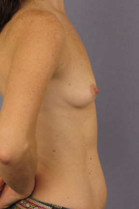 Breast Augmentation Before & After Patient #3873