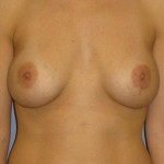 Breast Augmentation Before & After Patient #3883