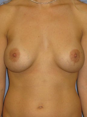 Breast Augmentation Before & After Patient #3883