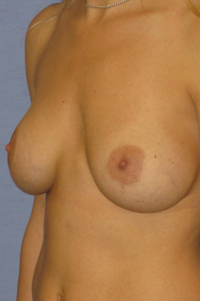 Breast Augmentation Before & After Patient #3883