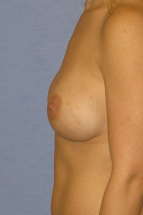 Breast Augmentation Before & After Patient #3883