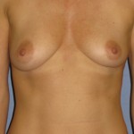 Breast Augmentation Before & After Patient #3896