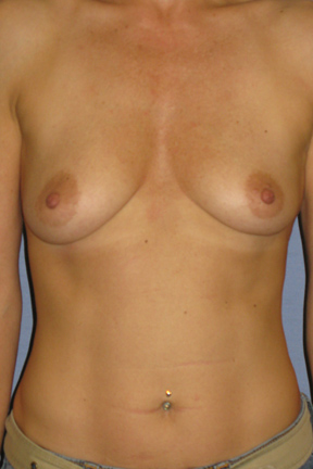 Breast Augmentation Before & After Patient #3896