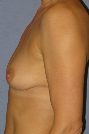 Breast Augmentation Before & After Patient #3896