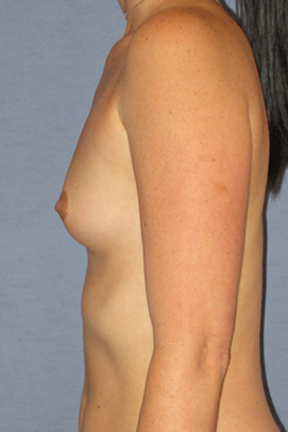 Breast Augmentation Before & After Patient #3652