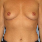 Breast Augmentation Before & After Patient #3940