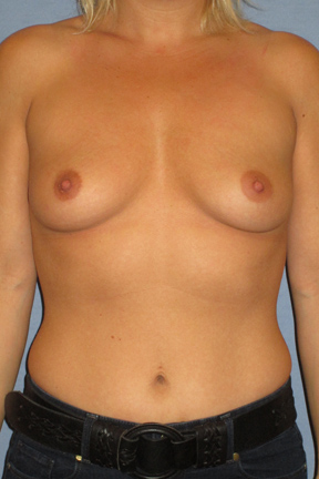 Breast Augmentation Before & After Patient #3940