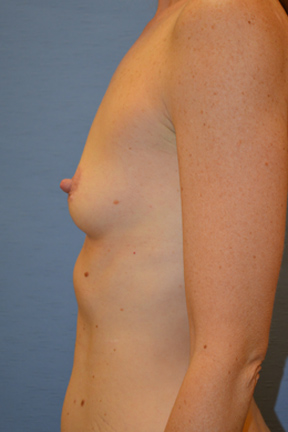 Breast Augmentation Before & After Patient #3921