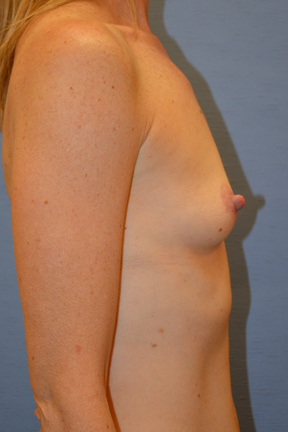 Breast Augmentation Before & After Patient #3921