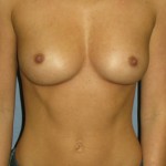 Breast Augmentation Before & After Patient #3663
