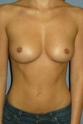 Breast Augmentation Before & After Patient #3663