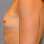 Breast Augmentation Before & After Patient #3774