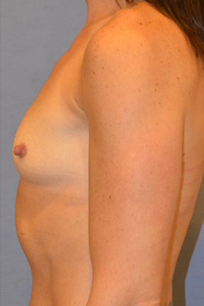 Breast Augmentation Before & After Patient #3774