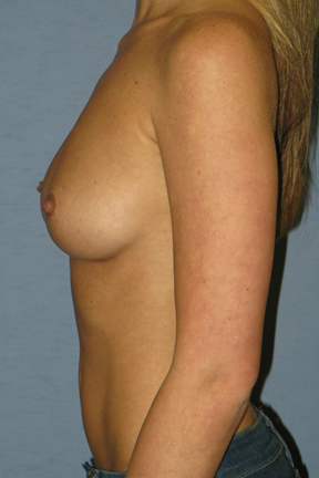 Breast Augmentation Before & After Patient #3663