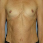 Breast Augmentation Before & After Patient #3628