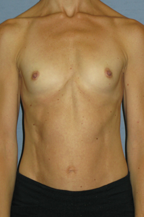 Breast Augmentation Before & After Patient #3628