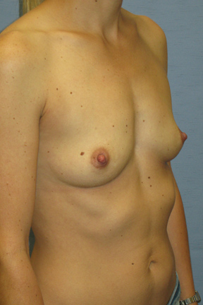 Breast Augmentation Before & After Patient #3674