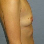 Breast Augmentation Before & After Patient #3674