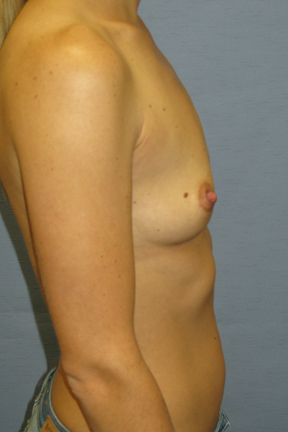 Breast Augmentation Before & After Patient #3674