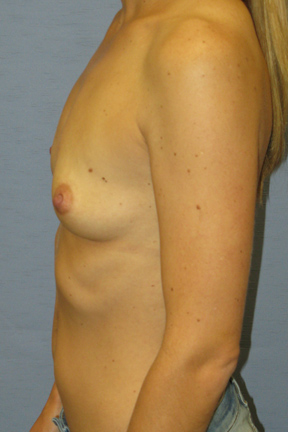 Breast Augmentation Before & After Patient #3674