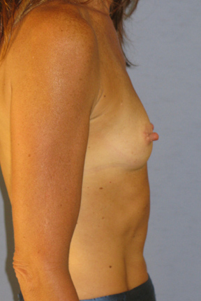 Breast Augmentation Before & After Patient #3688