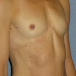 Breast Augmentation Before & After Patient #3697