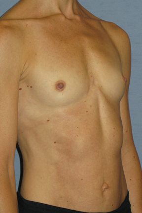 Breast Augmentation Before & After Patient #3697