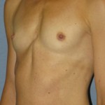 Breast Augmentation Before & After Patient #3697