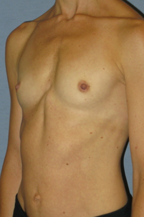 Breast Augmentation Before & After Patient #3697