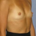 Breast Augmentation Before & After Patient #3707