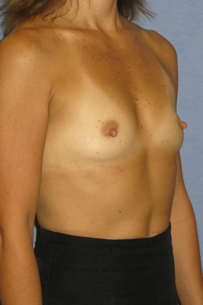 Breast Augmentation Before & After Patient #3707