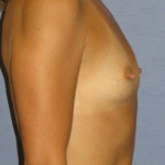 Breast Augmentation Before & After Patient #3707