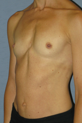 Breast Augmentation Before & After Patient #3628