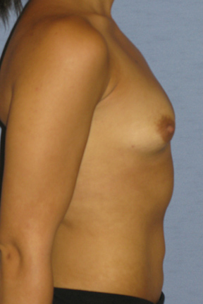 Breast Augmentation Before & After Patient #3715