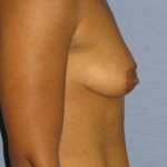 Breast Augmentation Before & After Patient #3720