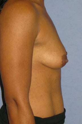 Breast Augmentation Before & After Patient #3720