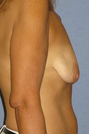 Breast Lift Before & After Patient #4039