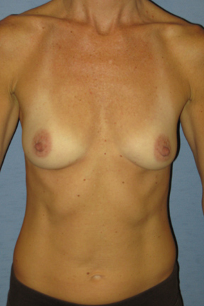 Breast Augmentation Before & After Patient #3641