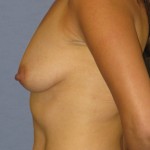 Breast Lift Before & After Patient #4044