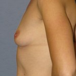 Breast Augmentation Before & After Patient #3738