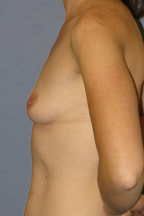 Breast Augmentation Before & After Patient #3738