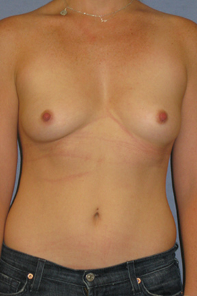 Breast Augmentation Before & After Patient #3752